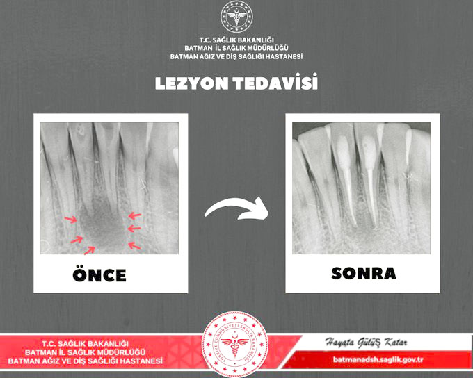 Diş hastanesinde başarılı tedavi ile diş kaybı önlendi