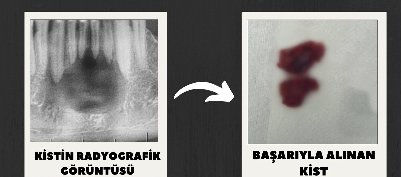 Ağız ve Diş Sağlığı Hastanesi’nde Başarılı Kist Ameliyatı
