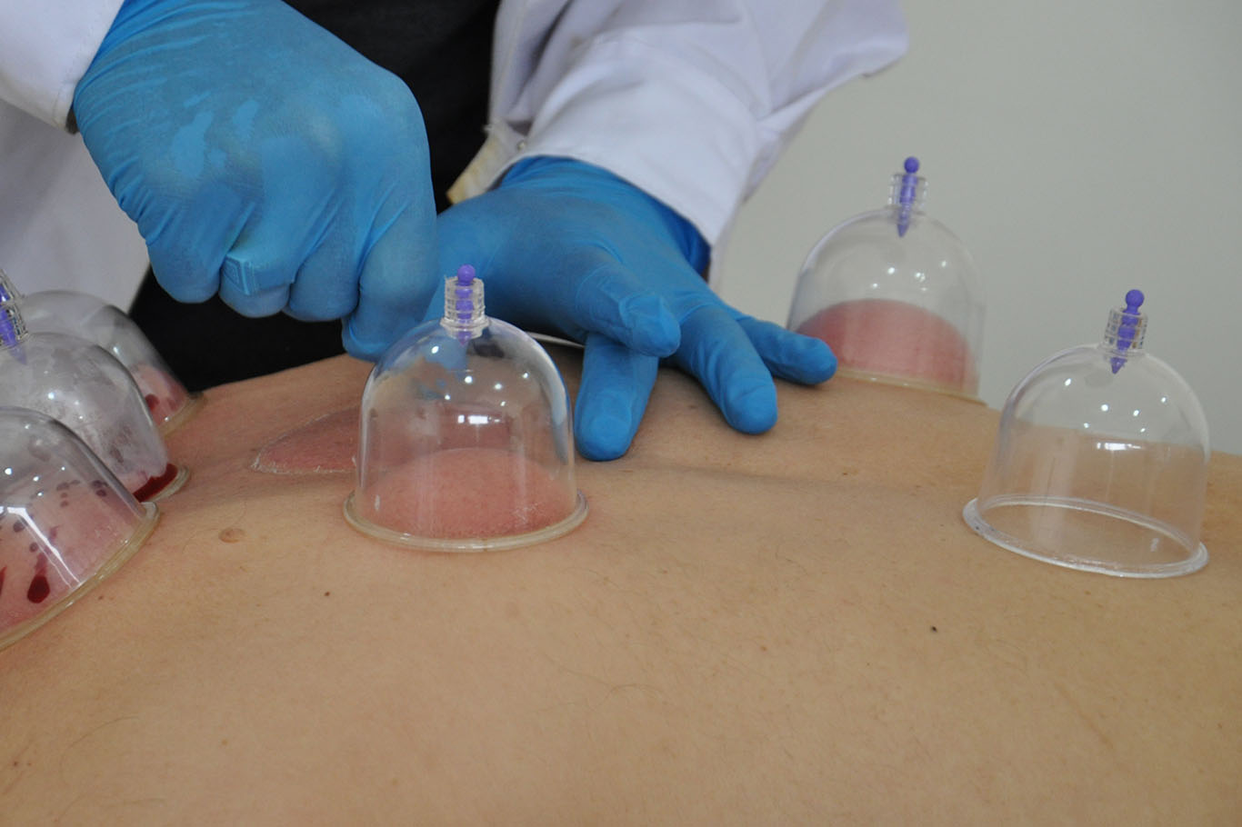 5000 Yıllık Geleneksel Yöntem: Hacamatın Faydaları Anlatıldı