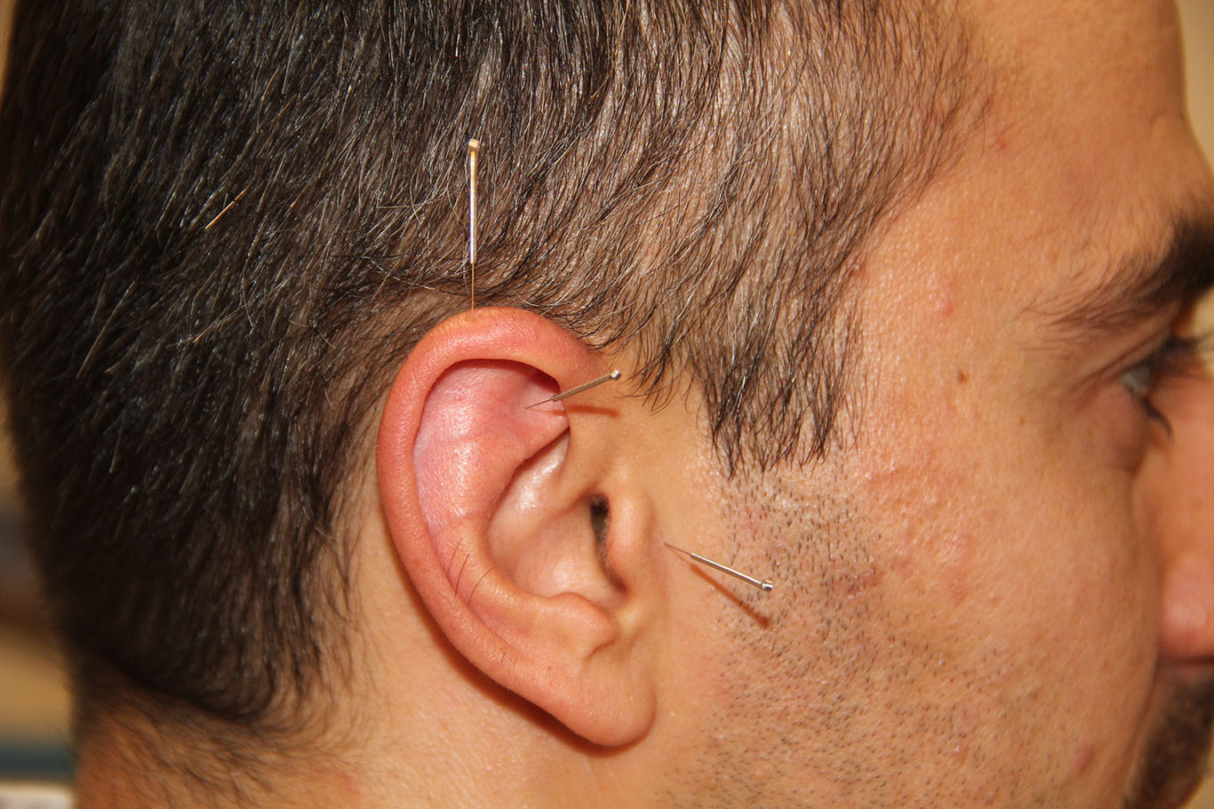 Akupunktur Tedavisi Binlerce Hastaya Umut Oldu