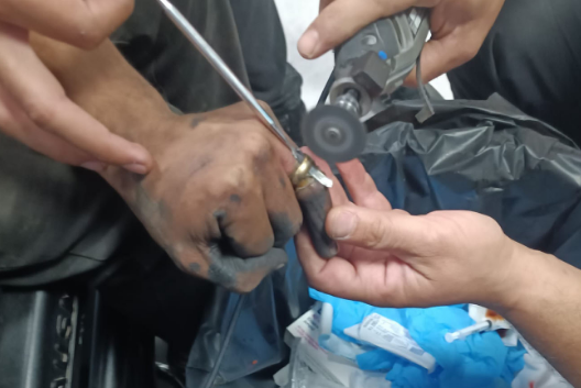 Parmağa Sıkışan Yüzük Çıkarıldı