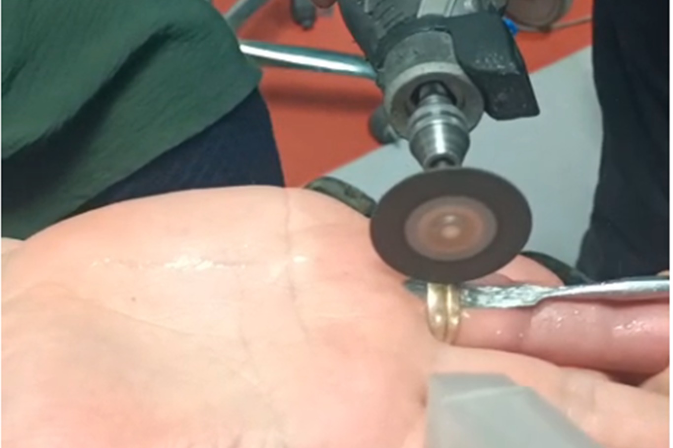 Parmağına Sıkışan Yüzük İtfaiye Tarafından Çıkarıldı